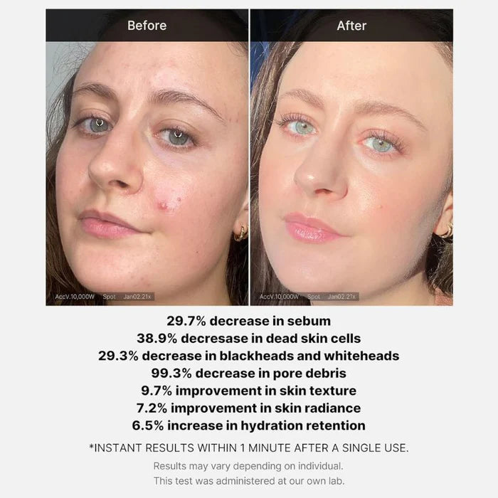 Medicube Red Acne Succinic Acid Peel 40g